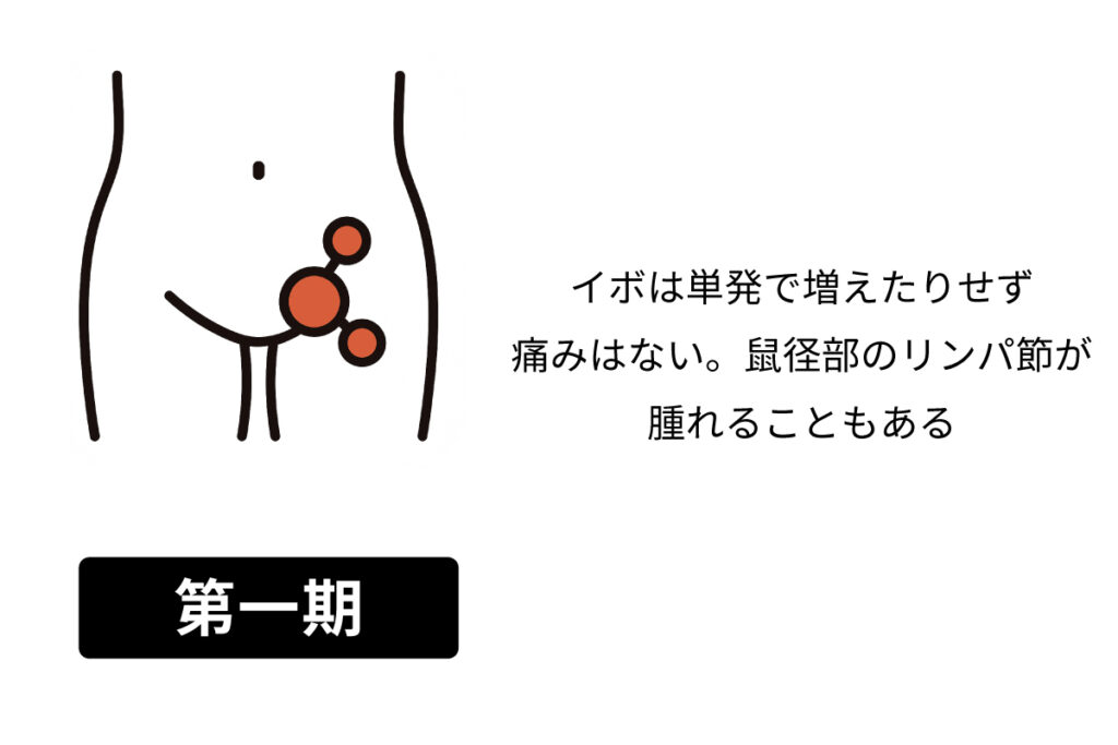 梅毒の症状1期