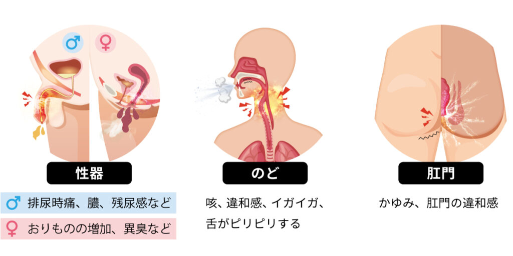 クラミジアの症状
<性器>
排尿痛、膿、残尿感
おりものの増加、異臭など
<のど>
喉違和感、イガイガ、舌がピリピリする
<肛門>
かゆみ、肛門の違和感
