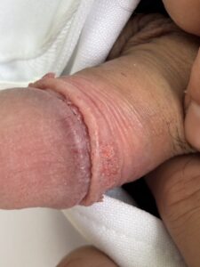 尖圭コンジローマの症例1