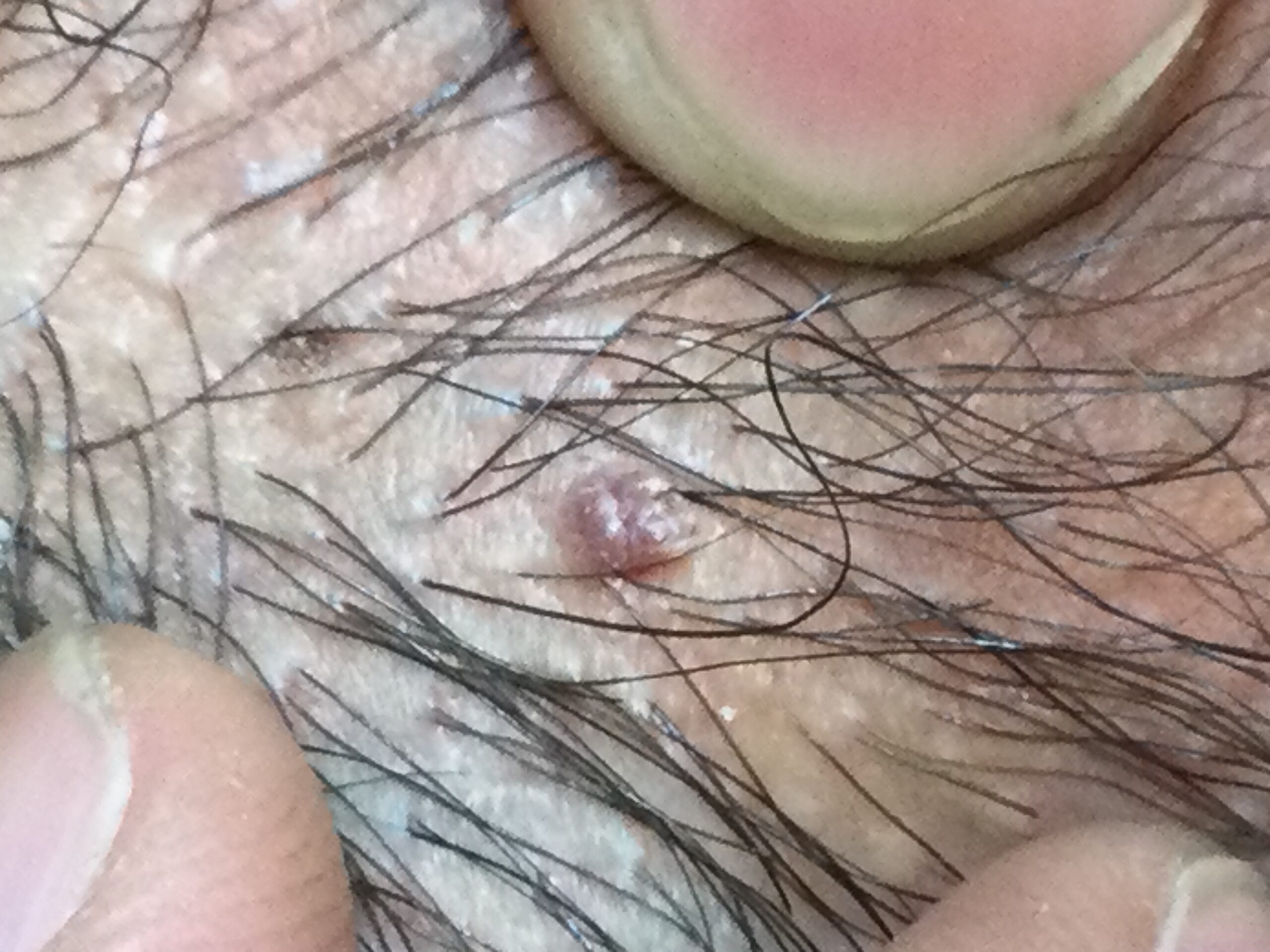 尖圭コンジローマ