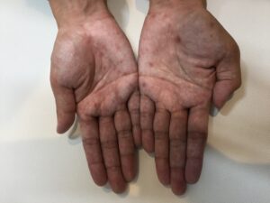 30代男性梅毒の症例