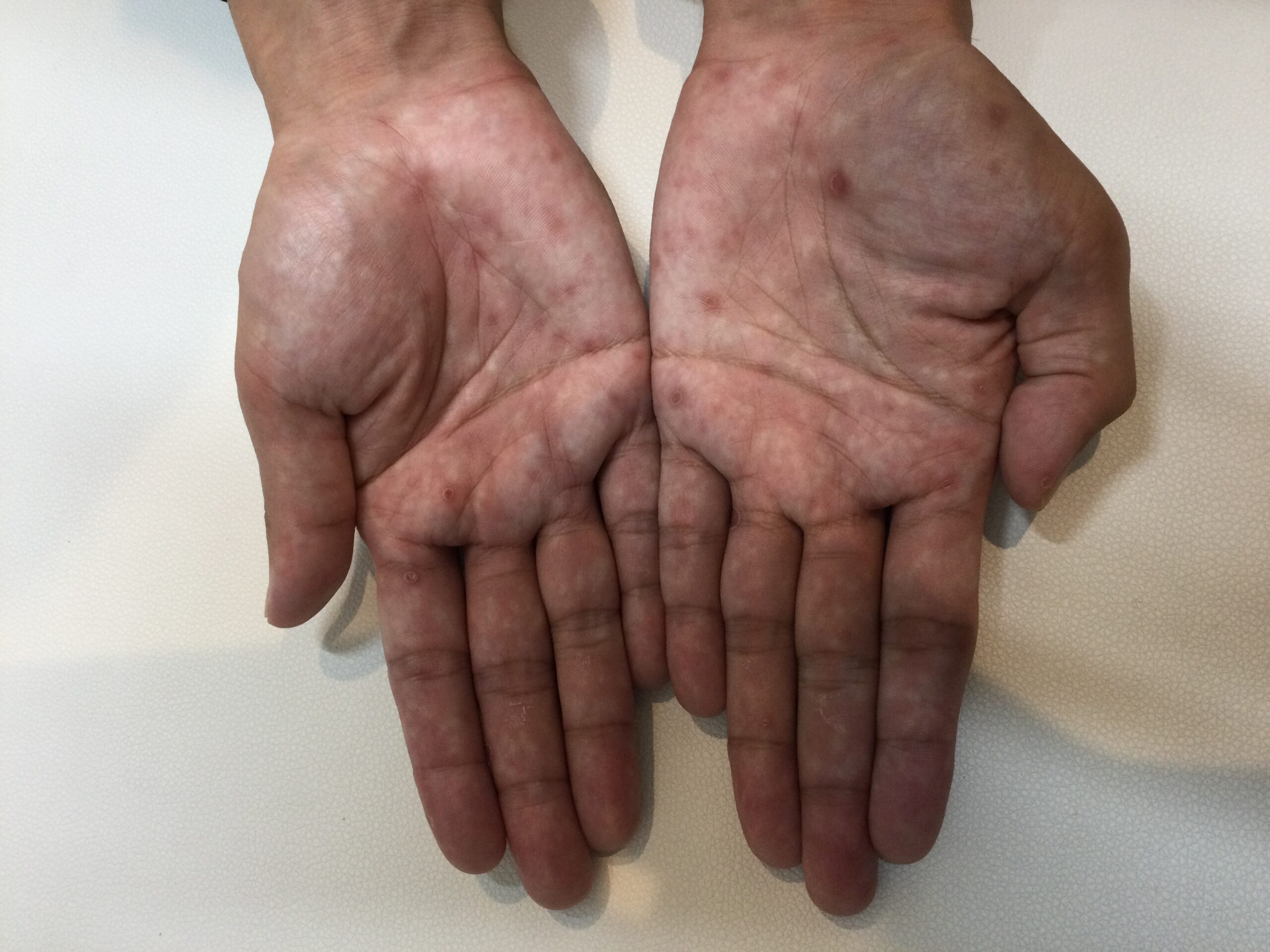 30代男性梅毒の症例