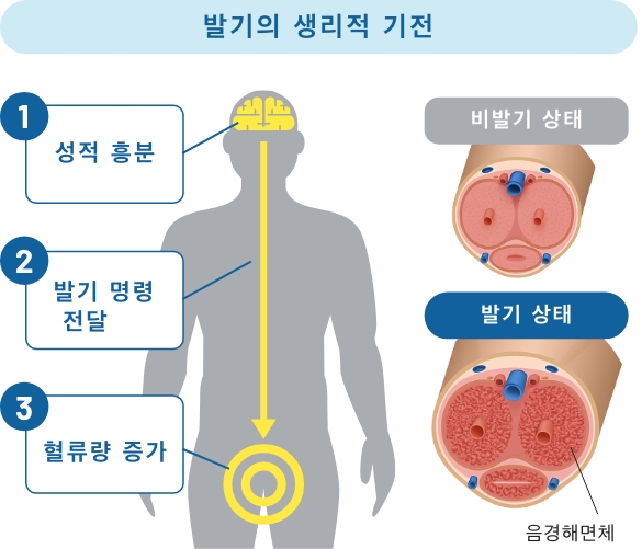 발기부전