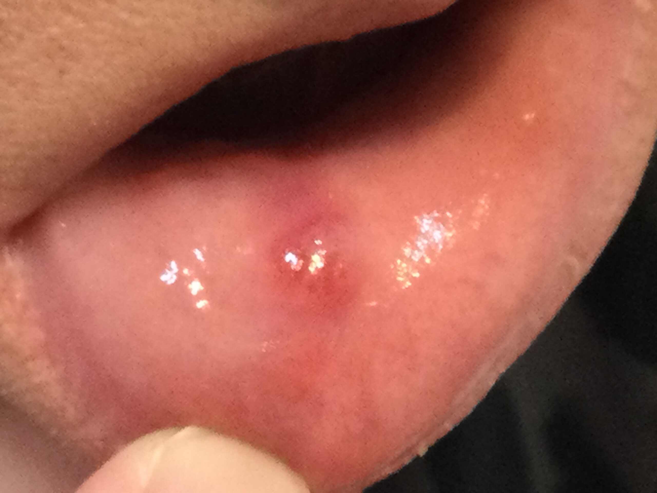 口唇ヘルペス症例