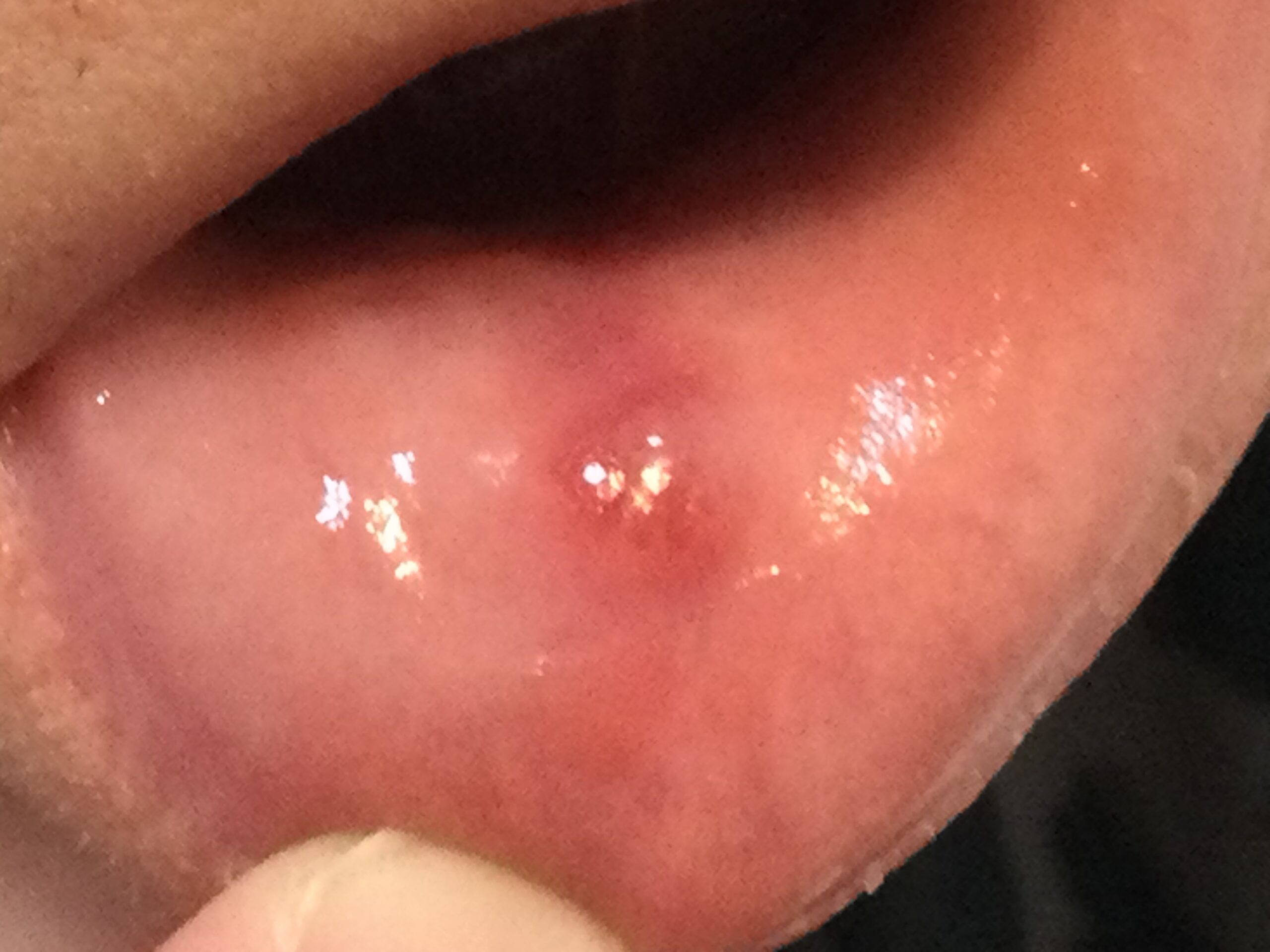 口唇ヘルペス症例