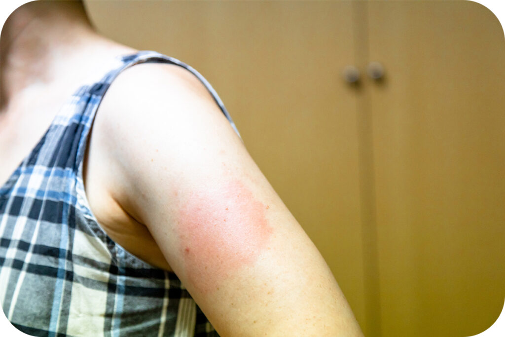 カビの一種で、主に性的接触を通じて人から人へ感染する新型の性感染症です。