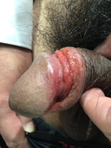 亀頭包皮炎症例