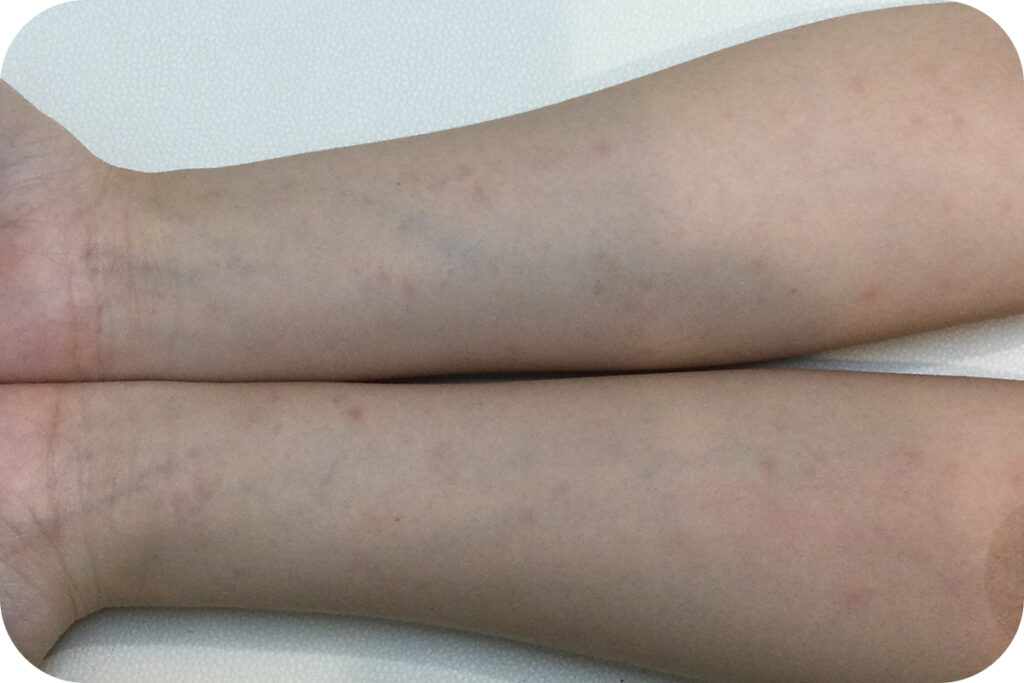 当院で梅毒診断された女性の腕の写真。